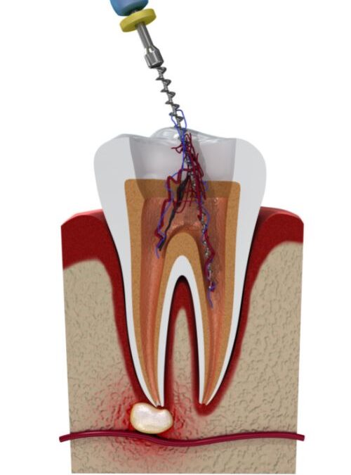 leczenie endodontyczne piaseczno estdental