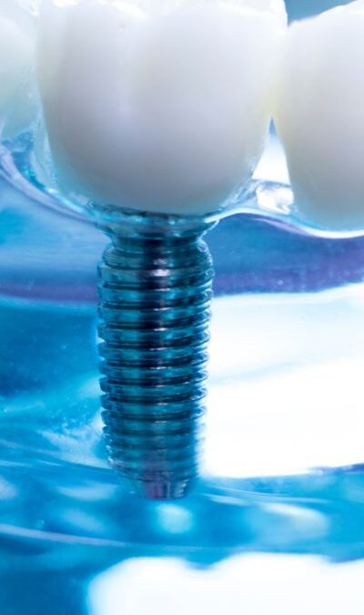 Implanty zębowe – zalecenia i&nbsp;wskazówki