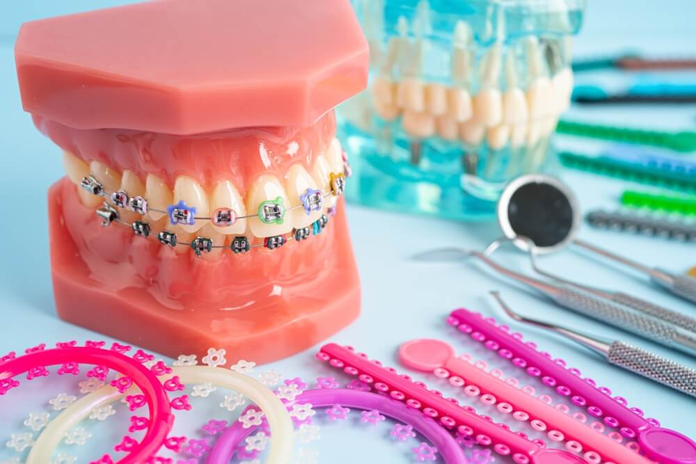 Aparat ortodontyczny ruchomy czy&nbsp;stały?