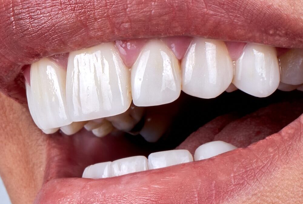 Bonding czy&nbsp;licówki?